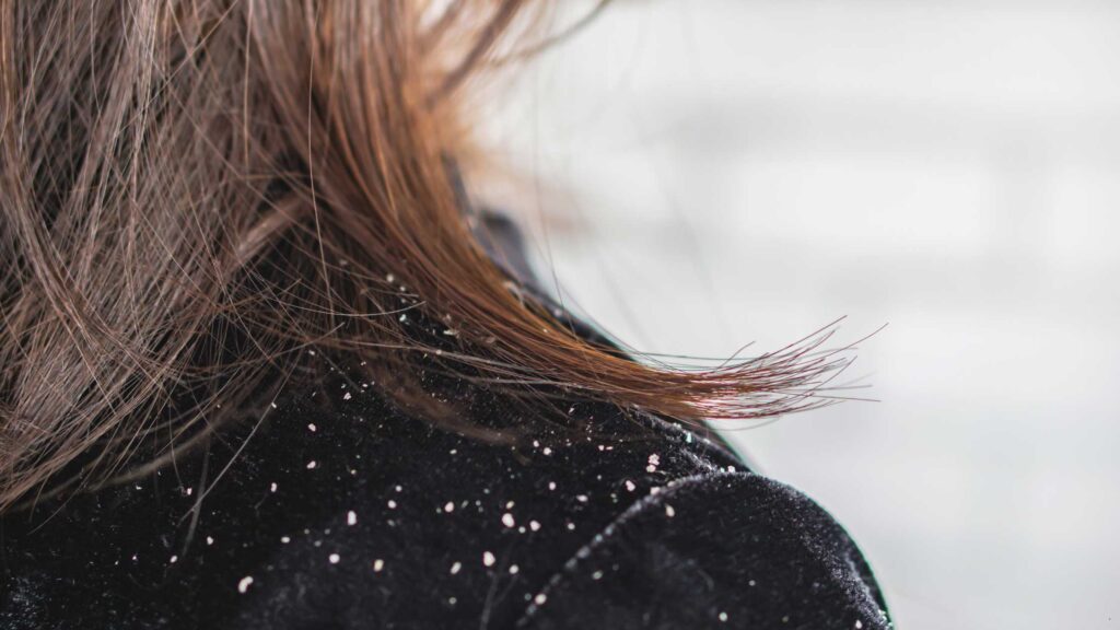 Dandruff Home Remedies and Treatments (1)