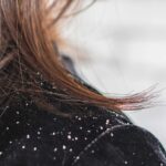 Dandruff Home Remedies and Treatments (1)