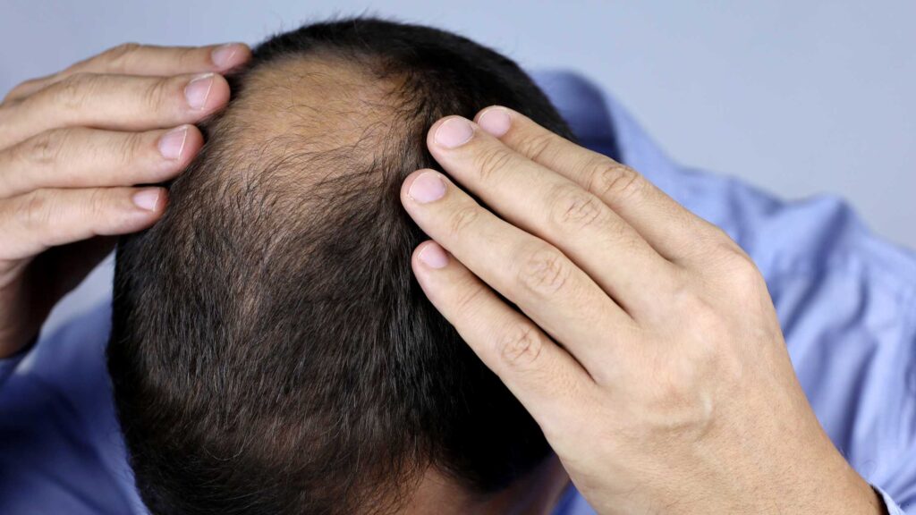 How to Prevent and Treat Baldhead