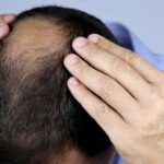 How to Prevent and Treat Baldhead