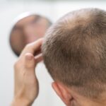 Hair Loss Explained: Causes, Myths & Treatments